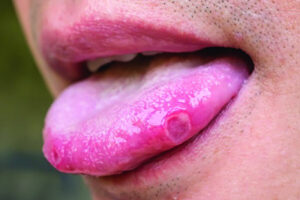 What is oral cancer?