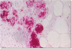 Mozzie watch intensifies as skin disease spread widens