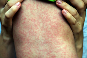 Measles detected