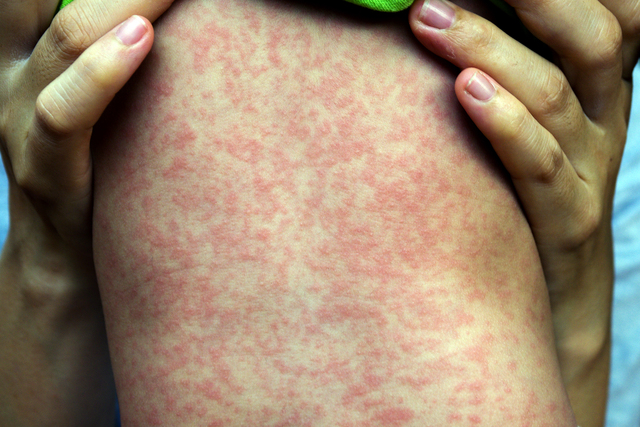 Measles detected
